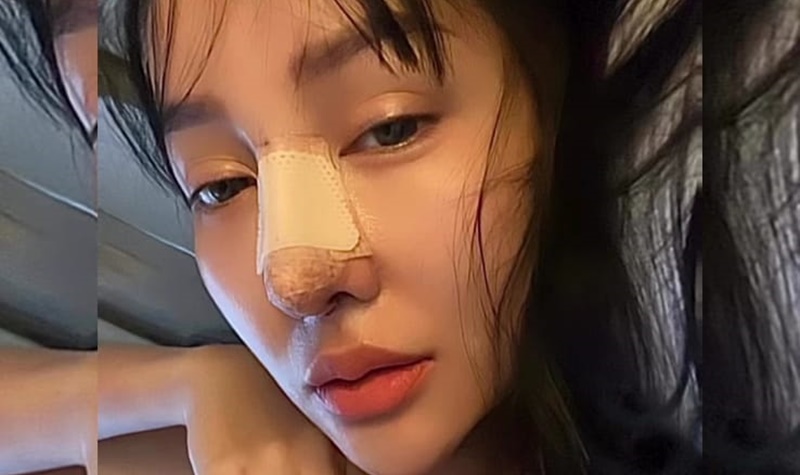 Begini Penampakan Wajah Lucinta Luna Usai Oplas Hidung