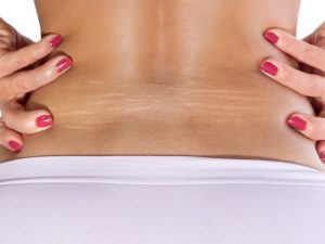 Cara menghilangkan stretch marks