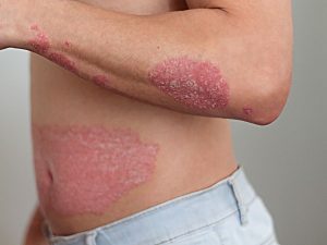 Psoriasis