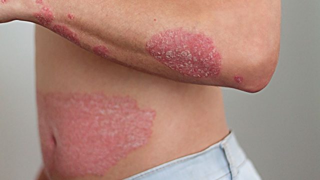 Psoriasis