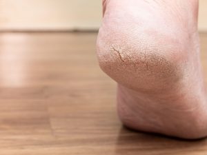 Berita gaya hidup, kesehatan, dan tips terbaru hari ini: Cara mengatasi kaki pecah-pecah atau heel fissures dapat menggunakan bahan alami ini.