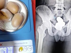 Berita terkini, terbaru, dan berita pilihan hari ini: Seorang pria di India ditangkap polisi lantaran ketahuan menyelundupkan hampir 1kg emas di dalam duburnya saat berada di bandara.
