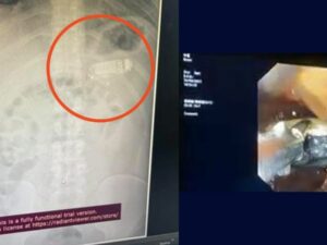 rita viral: Seorang pria telan ponsel Nokia 3310 selama empat hari dan harus mendapat pertolongan medis karena dapat membahayakan hidupnya.