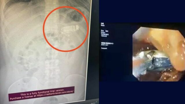 rita viral: Seorang pria telan ponsel Nokia 3310 selama empat hari dan harus mendapat pertolongan medis karena dapat membahayakan hidupnya.