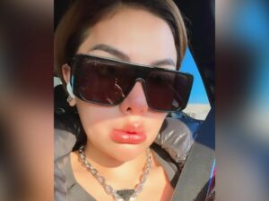 Berita artis: Bentuk bibir Nikita Mirzani disorot netizen atas foto terbaru yang ia unggah, terlihat lebih bengkak yang dikhawatirkan meletus.