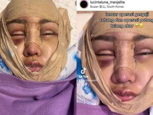Lucinta Luna baru saja memberikan kabar gembira bahwa dirinya berhasil melakukan operasi gergaji rahang dan juga tulang ekor, Selasa (12/7/2022).