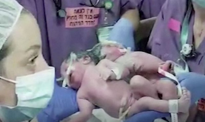 Momen Haru Bayi Kembar Siam Melakukan Kontak Mata Pertama Kalinya Setelah Operasi Pemisahan