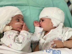 Momen Haru Bayi Kembar Siam Melakukan Kontak Mata Pertama Kalinya Setelah Operasi Pemisahan