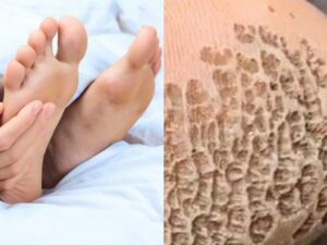 Pitted keratolysis atau dikenal dengan sebutan telapak kaki berlubang merupakan infeksi yang terjadi pada kulit akibat bakteri.
