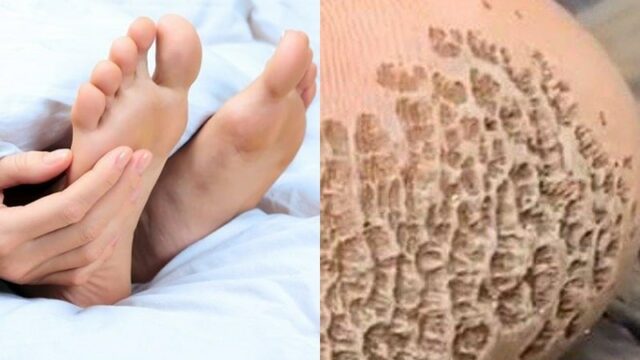 Pitted keratolysis atau dikenal dengan sebutan telapak kaki berlubang merupakan infeksi yang terjadi pada kulit akibat bakteri.