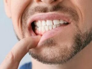 Cekricek.id - Kita mungkin pernah merasa gatal yang tiba-tiba di beberapa bagian tubuh. Namun, di antara banyaknya kemungkinan mungkin tak pernah terpikir bahwa kita akan mengalami rasa gatal itu di gusi. Meskipun rasa gatal pada gusi tidak selalu perlu dikhawatirkan, dalam beberapa kasus, kondisi ini dapat mengindikasikan adanya kondisi kesehatan tertentu.