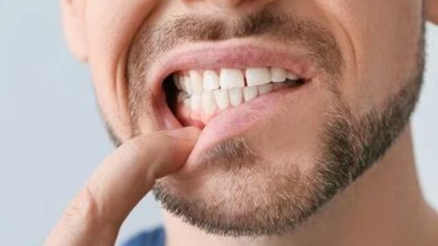 Cekricek.id - Kita mungkin pernah merasa gatal yang tiba-tiba di beberapa bagian tubuh. Namun, di antara banyaknya kemungkinan mungkin tak pernah terpikir bahwa kita akan mengalami rasa gatal itu di gusi. Meskipun rasa gatal pada gusi tidak selalu perlu dikhawatirkan, dalam beberapa kasus, kondisi ini dapat mengindikasikan adanya kondisi kesehatan tertentu.