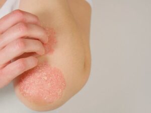 https://www.healthdigest.com/1017935/foods-to-eat-and-to-avoid-for-psoriasis/