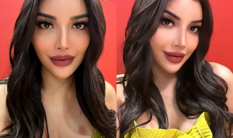 Millen Cyrus hebohkan warganet dengan sebuah bekas merah yang ada du bawah dadanya yang terlihat seperti sebuah bekas kecupan.