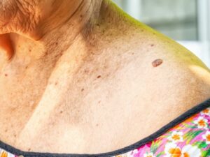 Cekricek.id - Berbagai macam orang khawatir keberadaan skin tag yang berada di area leher dapat menjadi penyakit berbahaya, seperti kanker
