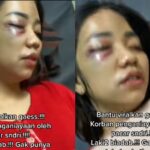Seorang wanita harus berbaring usai mendapatkan penganiayaan dari kekasihnya sendiri, wajahnya babak belur karena dianiaya kekasih sendiri.