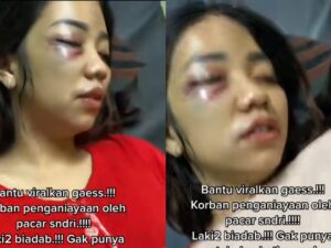Seorang wanita harus berbaring usai mendapatkan penganiayaan dari kekasihnya sendiri, wajahnya babak belur karena dianiaya kekasih sendiri.