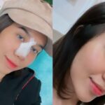 Cekricek.id - Mayang Lucyana yang sempat membuat gempar karena operasi plastik yang dijalaninya kini sudah melepas perban di hidungnya. Dia bahkan terlihat mengunggah konten video dengan penampakan hidung barunya yang mancung.