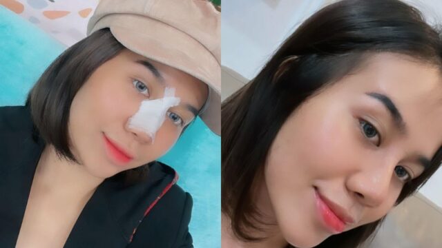 Cekricek.id - Mayang Lucyana yang sempat membuat gempar karena operasi plastik yang dijalaninya kini sudah melepas perban di hidungnya. Dia bahkan terlihat mengunggah konten video dengan penampakan hidung barunya yang mancung.