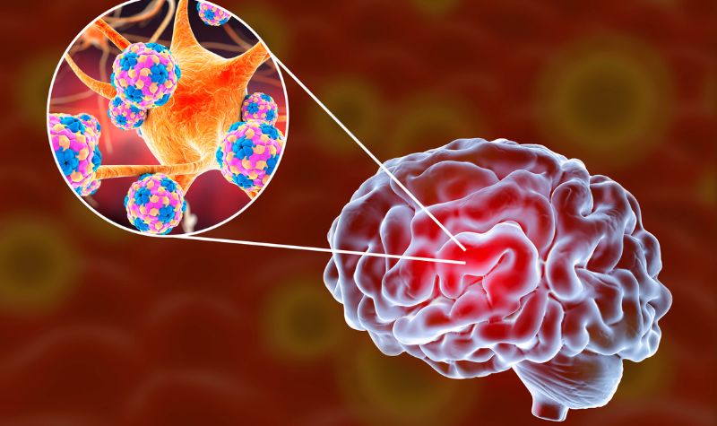 Wajib Waspadai 5 Gejala Meningitis yang Harus Diketahui Sejak Dini