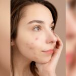 Cekricek.id - Bagi penderita jerawat hormonal ada cara mudah untuk menghempaskannya. Begini tips mudah dari dr Richard Lee