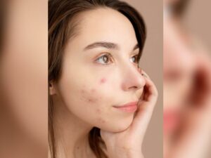Cekricek.id - Bagi penderita jerawat hormonal ada cara mudah untuk menghempaskannya. Begini tips mudah dari dr Richard Lee