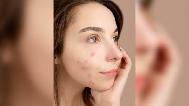 Cekricek.id - Bagi penderita jerawat hormonal ada cara mudah untuk menghempaskannya. Begini tips mudah dari dr Richard Lee
