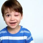 Cekricek.id - Adanya pembengkakan pada bagian jaringan tubuh dikenal dengan istilah angioedema. Kenali begini gejala serta pengobatannya