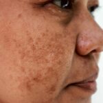 Cekricek.id, Kecantikan - Dengan bantuan treatment penghilang flek masalah yang ada pada wajah ini dapat diatasi dengan mudah