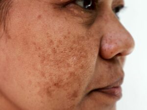 Cekricek.id, Kecantikan - Dengan bantuan treatment penghilang flek masalah yang ada pada wajah ini dapat diatasi dengan mudah
