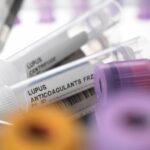 Cekricek.id, Kesehatan - Apakah Ada Hubungan Antara Lupus dan Anxiety?