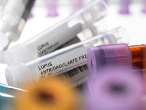 Cekricek.id, Kesehatan - Apakah Ada Hubungan Antara Lupus dan Anxiety?