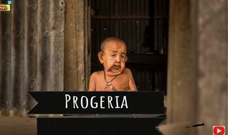 Cekricek.id, Kesehatan -  5 Penyakit Langka dan Paling Aneh yang Ada di Dunia