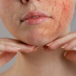Cekricek.id, Kesehatan - Mungkin banyak yang belum mengetahui berkaitan dengan penyakit kulit dengan nama rosacea, begini mengatasinya