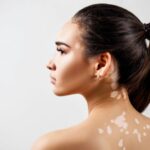 Cekricek.id, Kesehatan - Mengenal Vitiligo dan Cara Terbaik Penyembuhannya