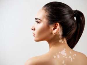 Cekricek.id, Kesehatan - Mengenal Vitiligo dan Cara Terbaik Penyembuhannya