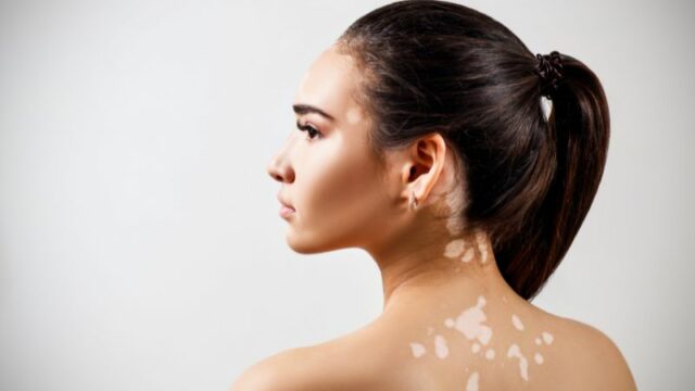 Cekricek.id, Kesehatan - Mengenal Vitiligo dan Cara Terbaik Penyembuhannya