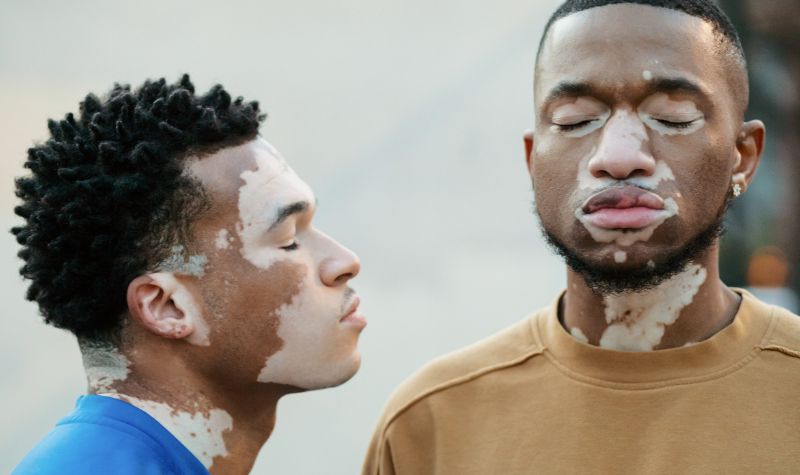 Cekricek.id, Kesehatan - Mengenal Vitiligo dan Cara Terbaik Penyembuhannya