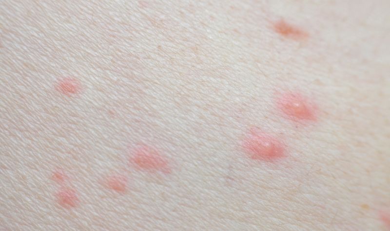 Cekricek.id, Kesehatan - Tidak ada salahnya jika antisipasi terhadap permasalahan kulit termasuk mengenal herpes zoster.