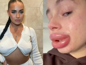 Filler Bibir Gagal Model Cantik Ini Kini Menyesal Bibirnya Jadi Bengkak