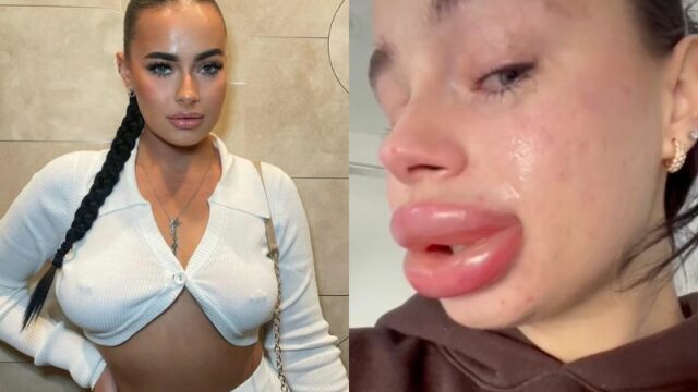 Filler Bibir Gagal Model Cantik Ini Kini Menyesal Bibirnya Jadi Bengkak