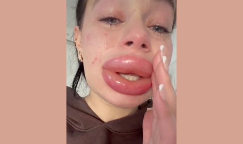 Filler Bibir Gagal Model Cantik Ini Kini Menyesal Bibirnya Jadi Bengkak