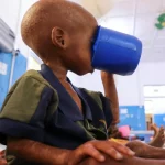 Seorang anak Somalia yang menderita gizi buruk minum di fasilitas kesehatan