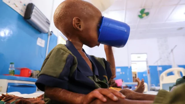 Seorang anak Somalia yang menderita gizi buruk minum di fasilitas kesehatan