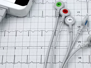 Ilustrasi rekaman elektrokardiogram (EKG)