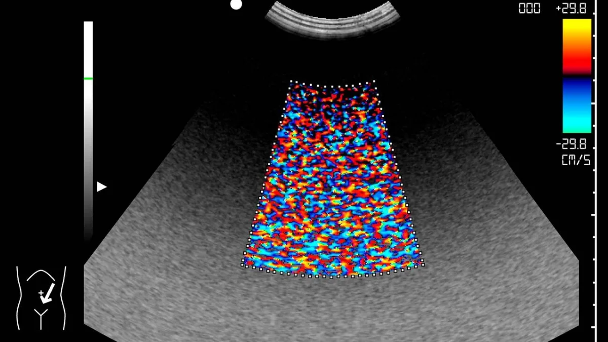 Citra ultrasonografi Doppler warna memperlihatkan bercak merah dan biru berhamburan sebagai artefak derau