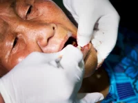 Dokter gigi mencabut gigi perempuan lansia dalam layanan gigi gratis di Ulaanbaatar, Mongolia