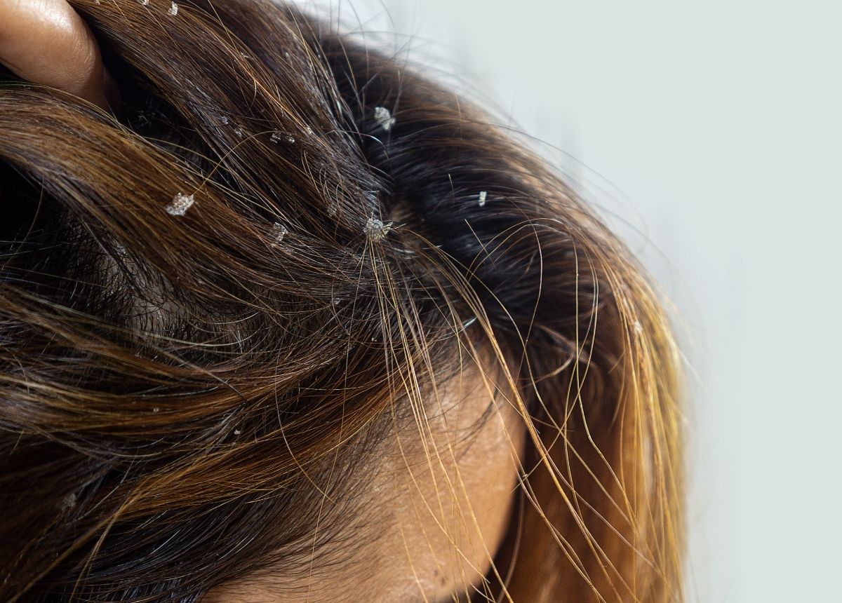 Dermatitis seboroik merupakan penyakit kulit yang sering terjadi di kulit kepala dan menyebabkan gatal. Ini lah beberapa faktor dan gejala dari Dermatitis seboroik.