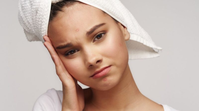 Anda bisa mencegah kulit terutama muka tidak berjerawat. Paling mudah, anda bisa menghindari jenis makanan yang mengandung beberapa bahan ini