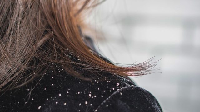 Berita gaya hidup, kesehatan, dan tips terbaru hari ini: 4 cara ini bisa anda lakukan untuk hilangkan ketombe. Anda bisa rajin keramas, menggunakan tea tree oil, kurangi konsumsi gula dan mencoba cuka apel.